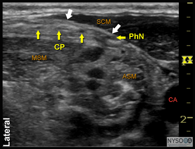 Ultrasound Guided Superficial Cervical Plexus Block NYSORA The New