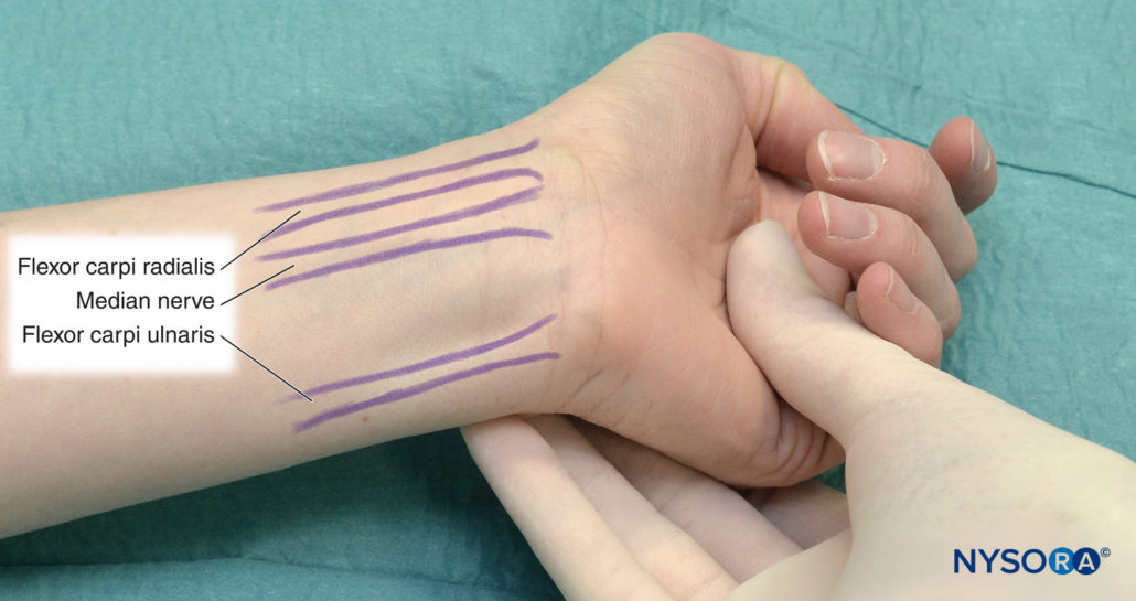 Regional Anesthesia Tendons Of The Wrist Flexors And Position Of The