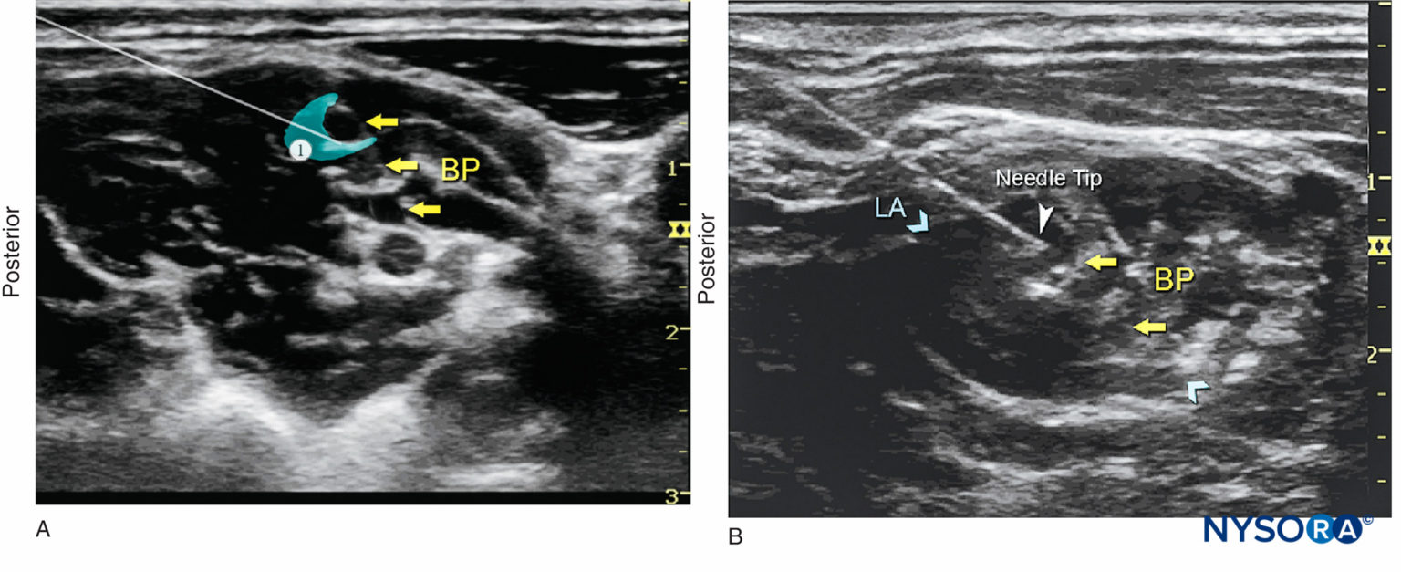 Ultrasound Guided Interscalene Brachial Plexus Nerve Block Nysora