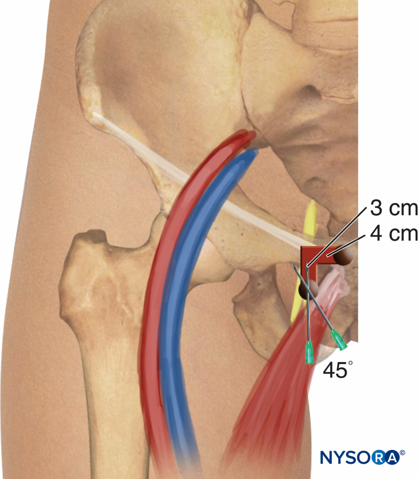 Regional Anesthesia Obturator Nerve Block Simplified Labat Classic