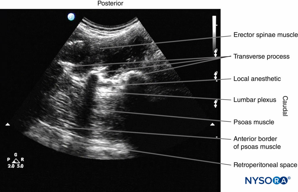 Regional Anesthesia Sagittal Sonogram Of The Lumbar Paravertebral