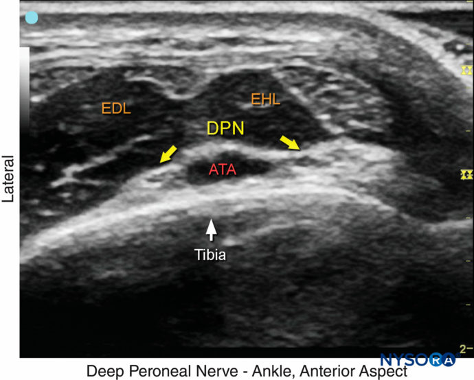 Regional Anesthesia Ultrasound Image Of The Deep Peroneal Nerve Nysora