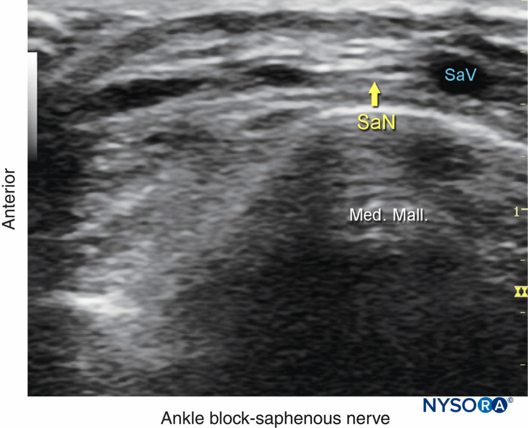 Regional Anesthesia Us Anatomy Of The Saphenous Nerve NYSORA