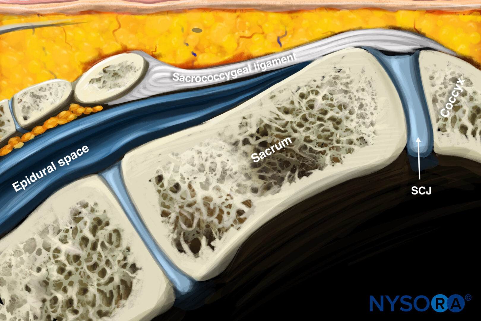 15 Ganglion Impar Injection Fig 4 Rev NYSORA