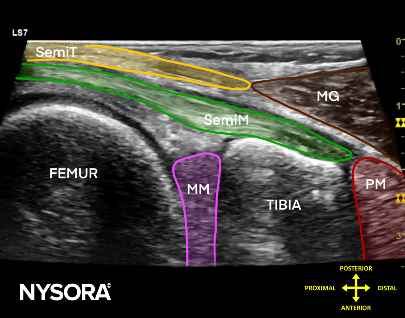 Tips For Scanning Bakers Cyst In A Longitudinal Orientation Nysora