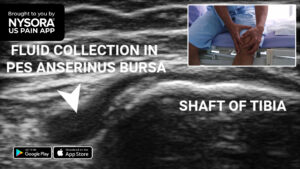 Case Study Pes Anserinus Bursitis Injection NYSORA