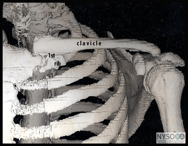 Supraclavicular Brachial Plexus Block Nysora The New