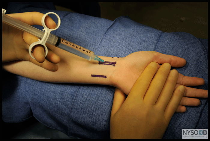 wrist-block-nysora-the-new-york-school-of-regional-anesthesia