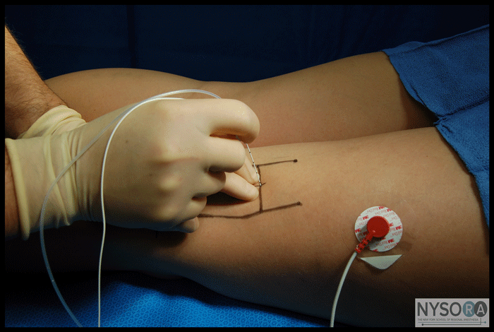 Popliteal Sciatic Nerve Blocks: Intertendinous / Lateral Approach