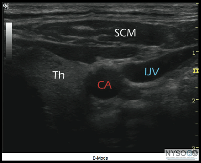 Ultrasound Physics - NYSORA The New York School of Regional Anesthesia