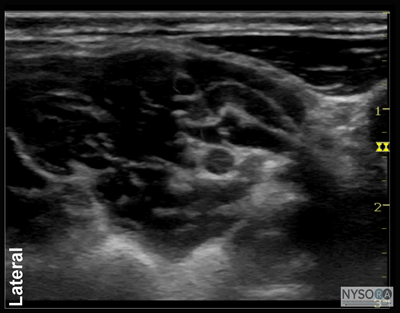 Ultrasound-Guided Interscalene Brachial Plexus Block - NYSORA The New ...