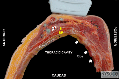 Ultrasound-guided Supraclavicular Brachial Plexus Block - Nysora The 