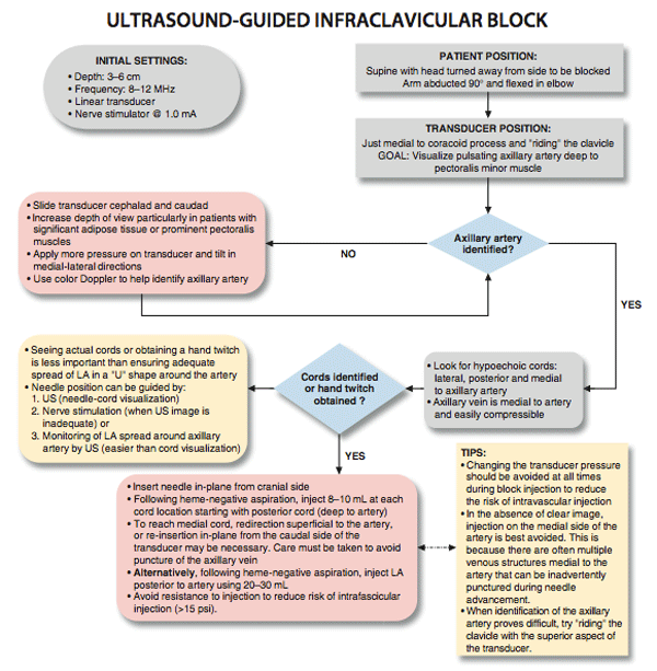 Ultrasound-guided Infraclavicular Brachial Plexus Block - Nysora The 