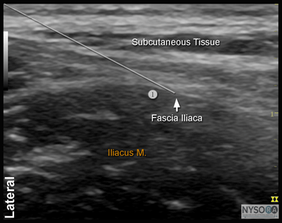 Ultrasound-Guided Fascia Iliaca Block - NYSORA The New York School Of ...