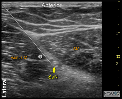 Ultrasound-Guided Saphenous Nerve Block - NYSORA The New York School of ...