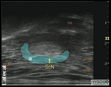 Ultrasound Guided Popliteal Sciatic Block - NYSORA The New York School ...