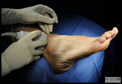 Ultrasound Guided Ankle Block - NYSORA The New York School of Regional ...