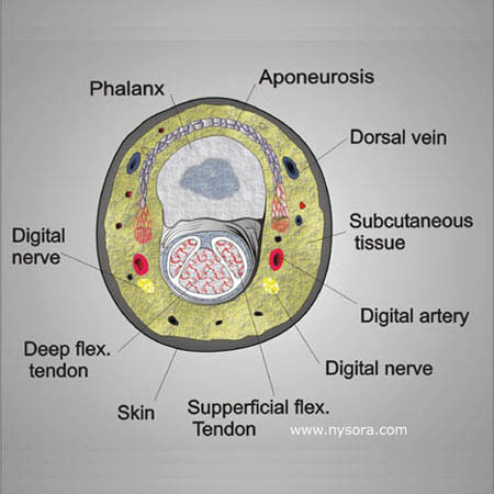 Digital Nerve Block - NYSORA The New York School of Regional Anesthesia