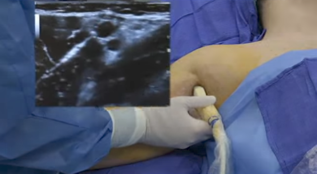 Axillary-Brachial-Plexus-Block-Video_NYSORA - NYSORA