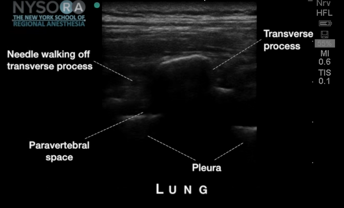 Ultrasound-Guided Paravertebral Block - Out of Plane Technique Video