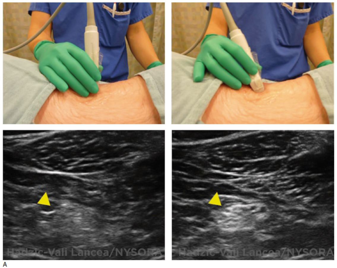 Introduction to Ultrasound-Guided Regional Anesthesia - NYSORA The New ...