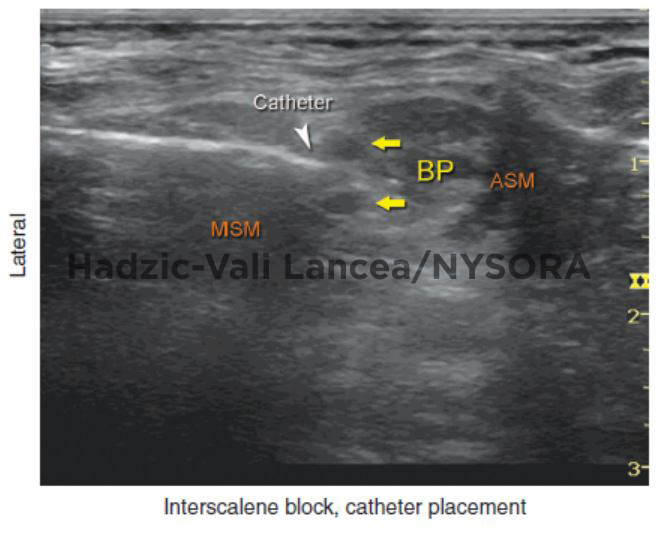 Ultrasound-Guided Interscalene Brachial Plexus Block - NYSORA The New ...