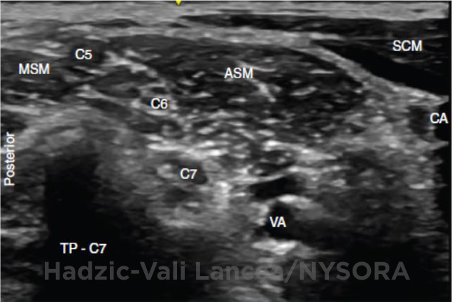 Ultrasound-Guided Interscalene Brachial Plexus Block - NYSORA The New ...