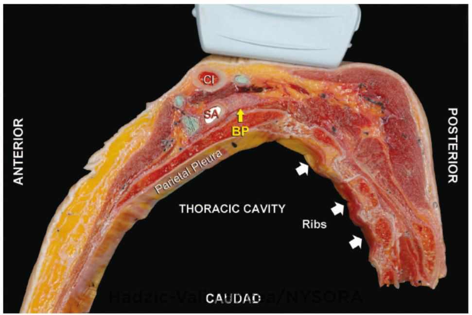 Ultrasound Guided Supraclavicular Brachial Plexus Block