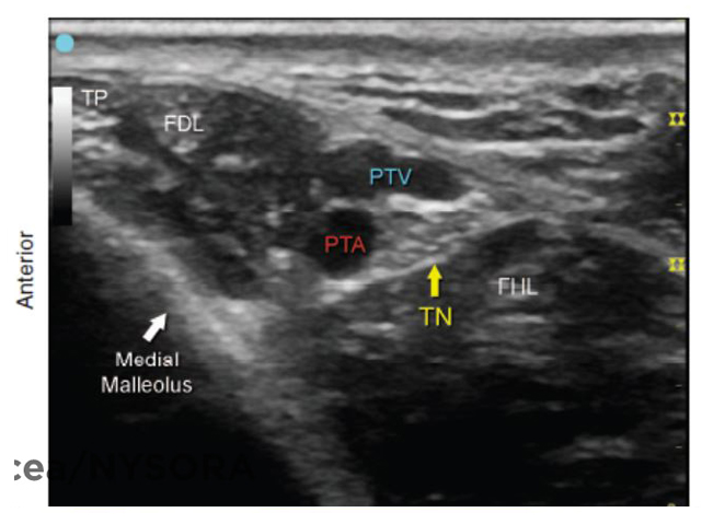 Posterior Tibial Nerve Block Ultrasound