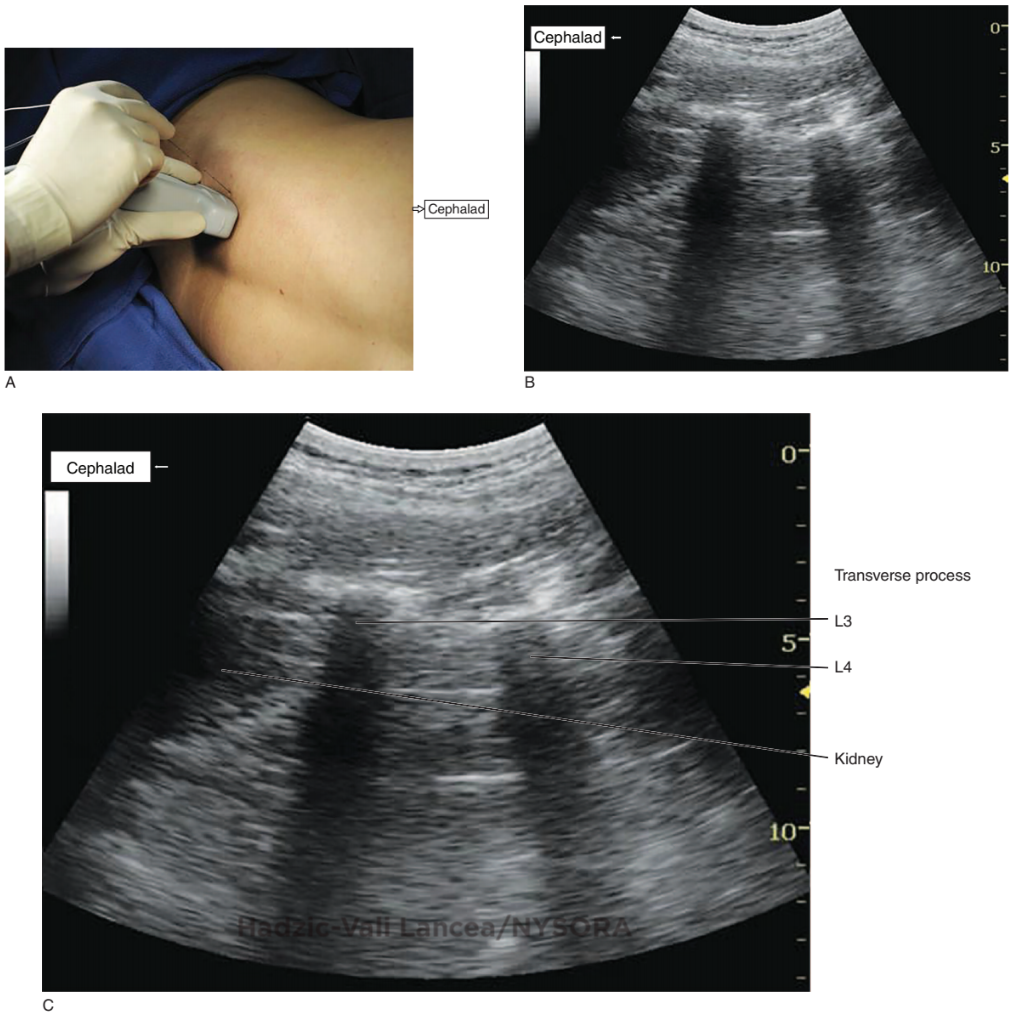 Ultrasoundguided Infraclavicular Brachial Plexus Block