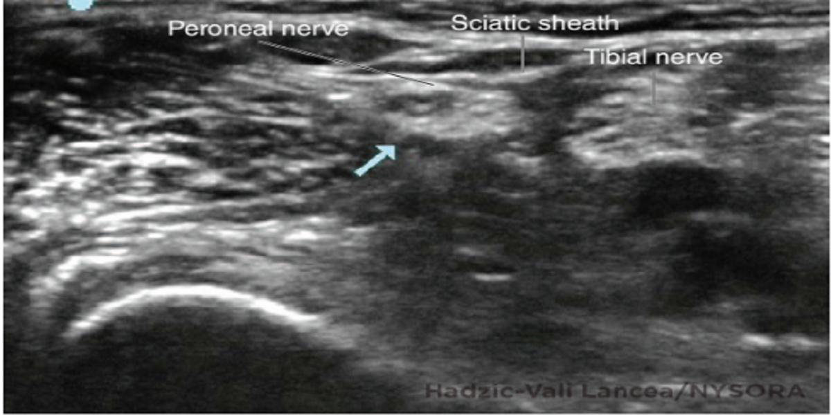 Peripheral Nerve Blocks for Children - NYSORA The New York School of ...