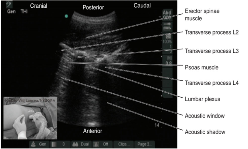 Lumbar Plexus Ultrasound