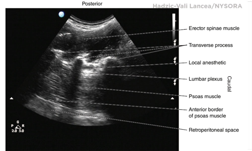 Lumbar Plexus Block Ultrasound