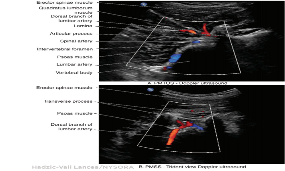 Lumbar Paravertebral Sonography And Considerations For Ultrasound