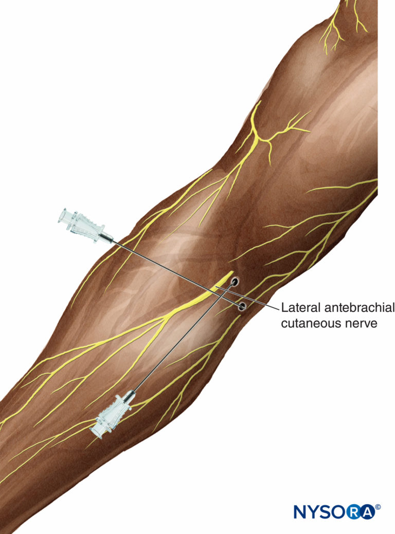 Cutaneous Blocks for the Upper Extremity - Landmarks and Nerve ...