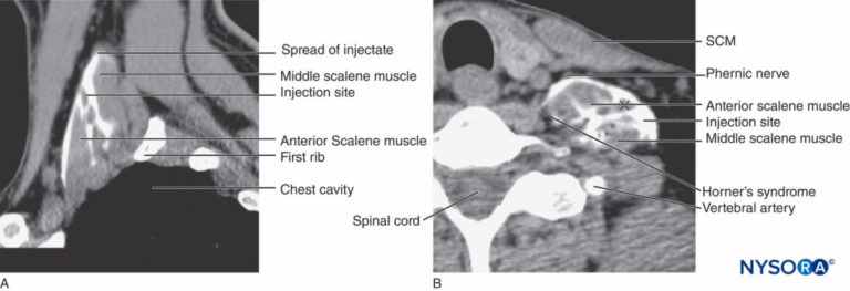 Regional-anesthesia-local-anesthetic-spread-interscalene-space - Nysora