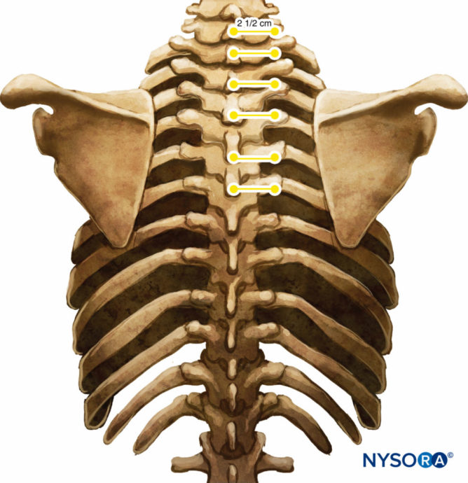 Thoracic and Lumbar Paravertebral Block - Landmarks and Nerve ...