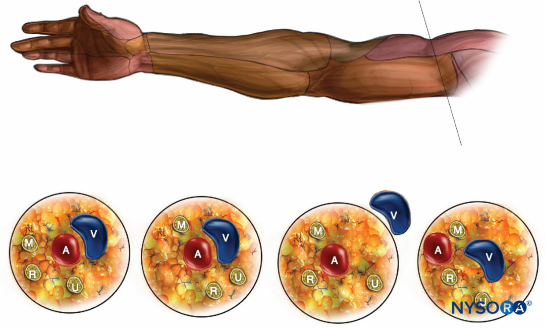 Axillary Brachial Plexus Block Landmarks And Nerve Stimulator Technique NYSORA