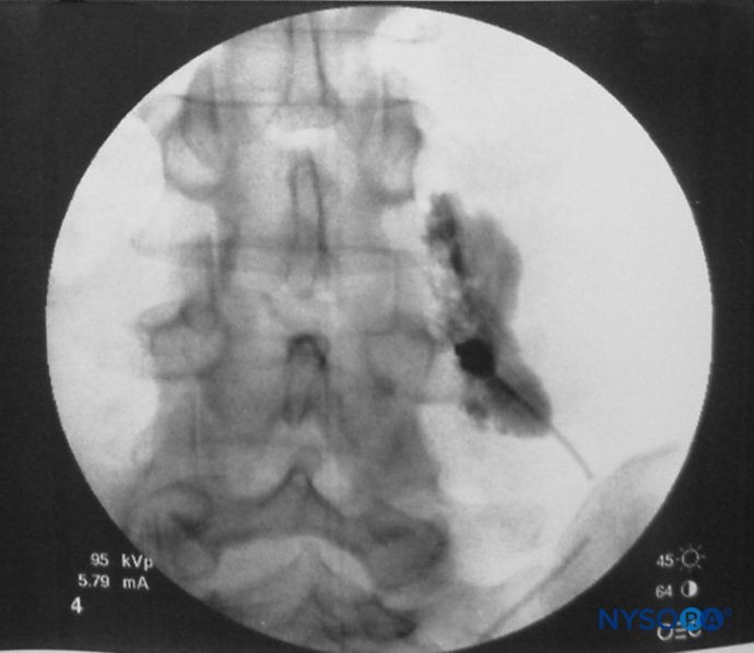 regional-anesthesia-spread-of-local-anesthetic-solution-paravertebral ...