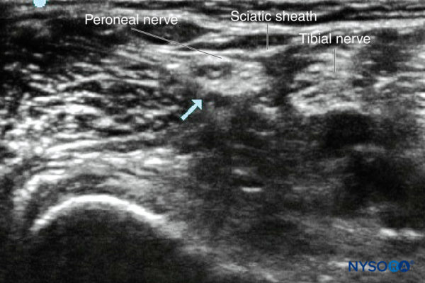 Peripheral Nerve Blocks for Children - NYSORA