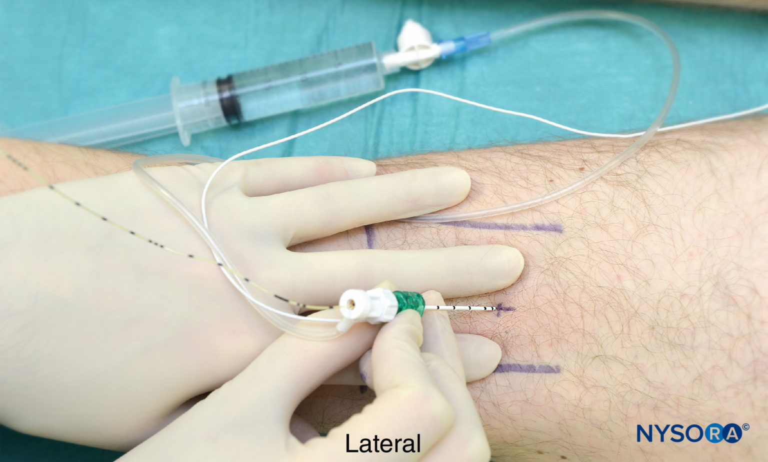 Popliteal Sciatic Nerve Block - Landmarks and Nerve Stimulator ...