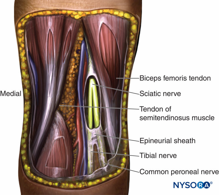 Popliteal Sciatic Nerve Block - Landmarks and Nerve Stimulator ...