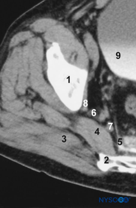 Sciatic Nerve Block Landmarks And Nerve Stimulator Technique NYSORA NYSORA