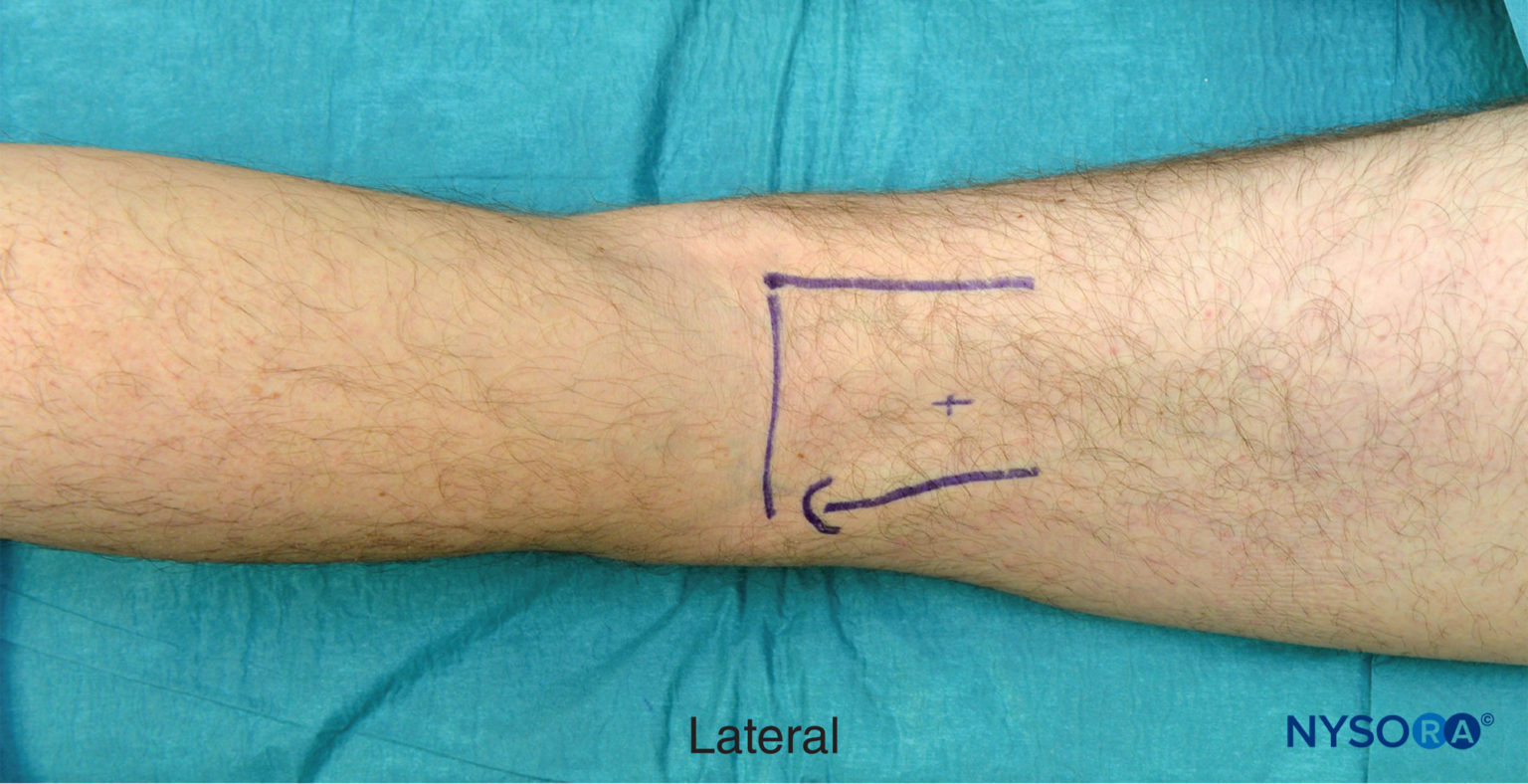 Popliteal Sciatic Nerve Block - Landmarks and Nerve Stimulator ...