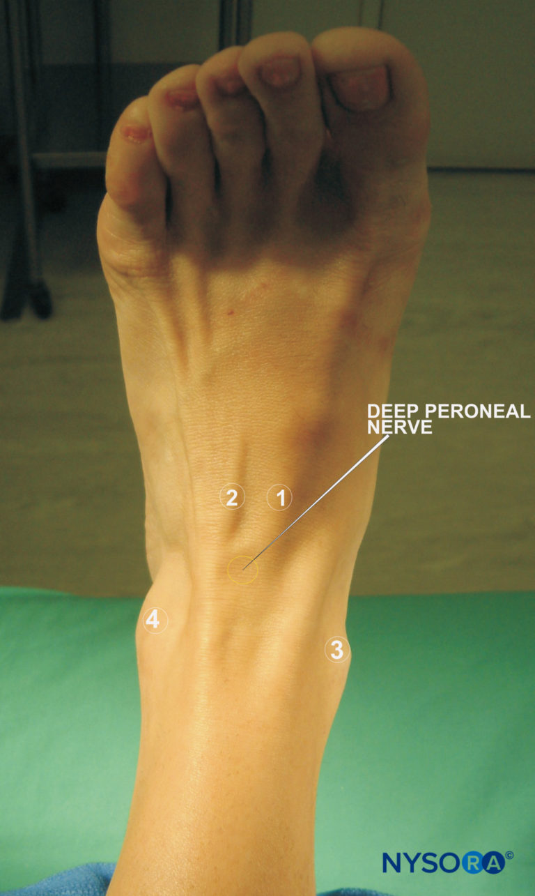 Ankle Block - Landmarks and Nerve Stimulator Technique - NYSORA