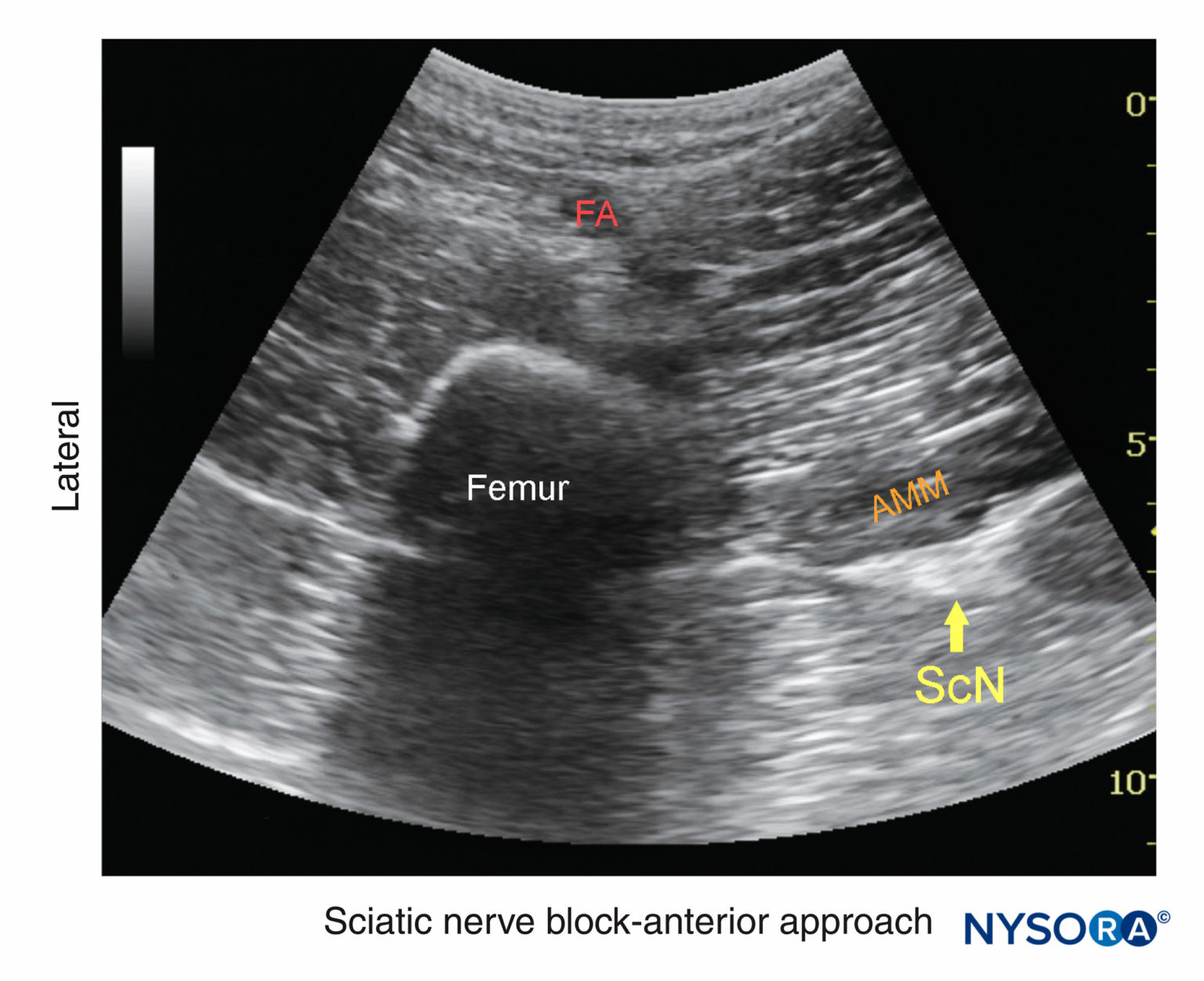 Ultrasound Guided Sciatic Nerve Block Nysora Nysora