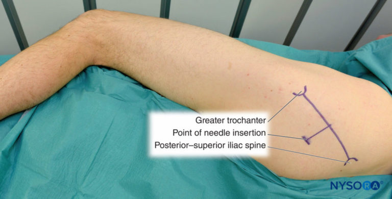 Sciatic Nerve Block - Landmarks And Nerve Stimulator Technique - NYSORA ...