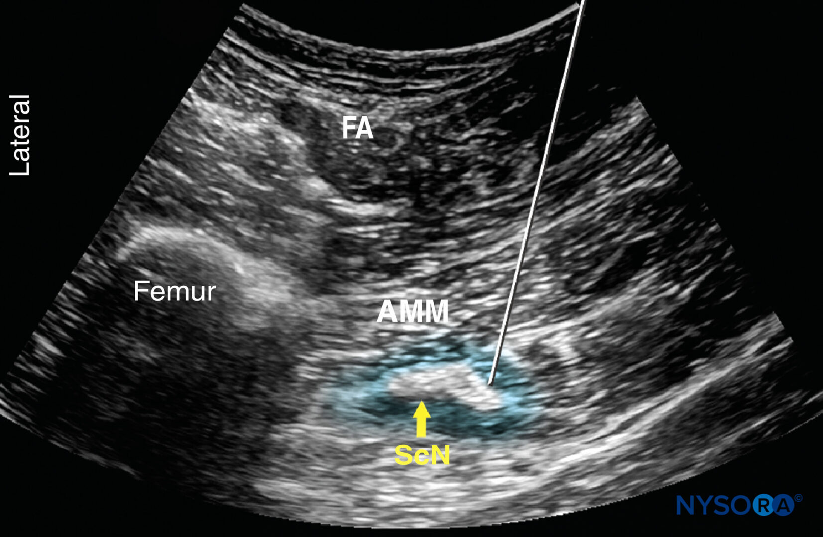 Ultrasound-Guided Sciatic Nerve Block - NYSORA | NYSORA