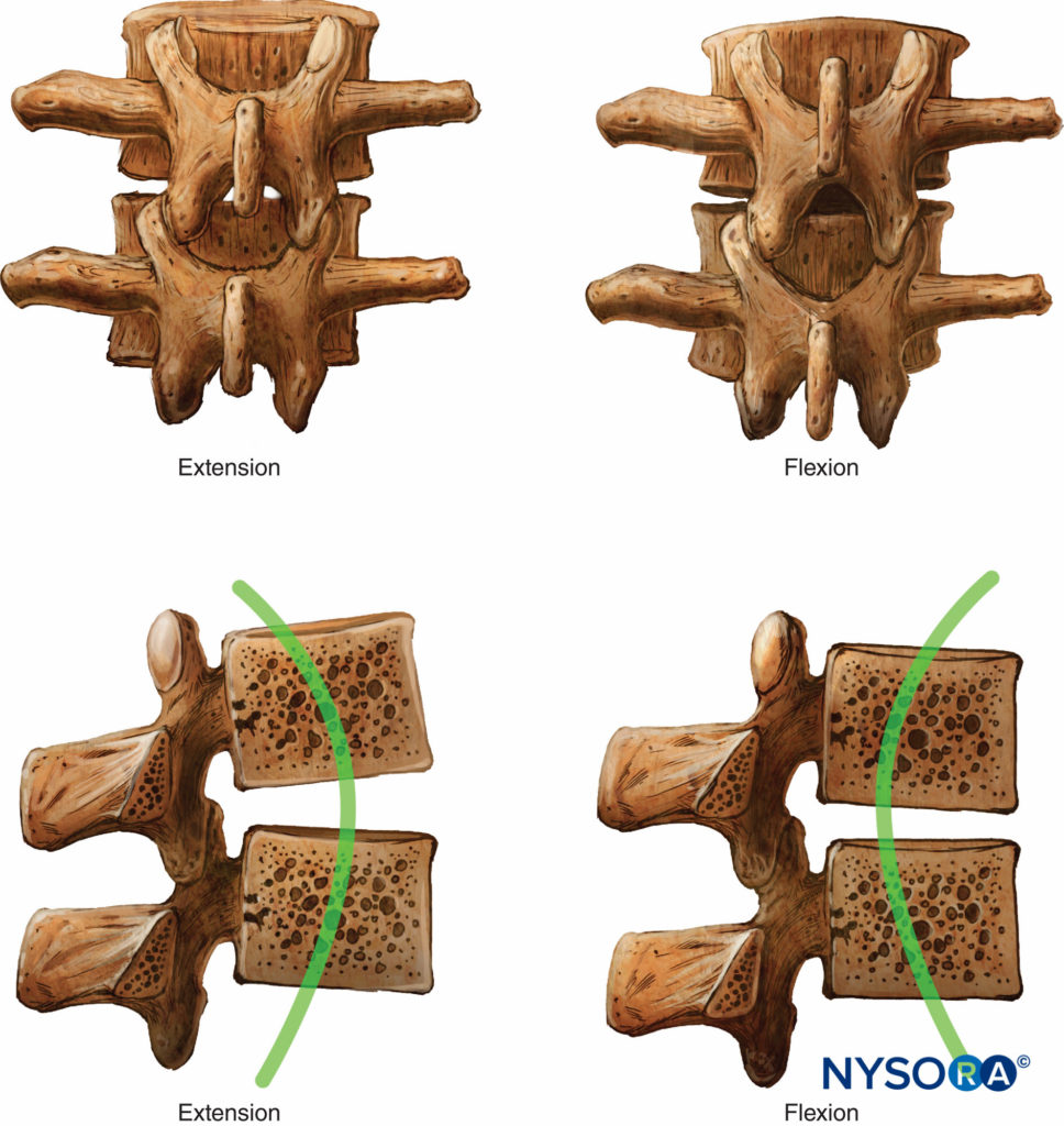 Epidural Anesthesia And Analgesia - NYSORA