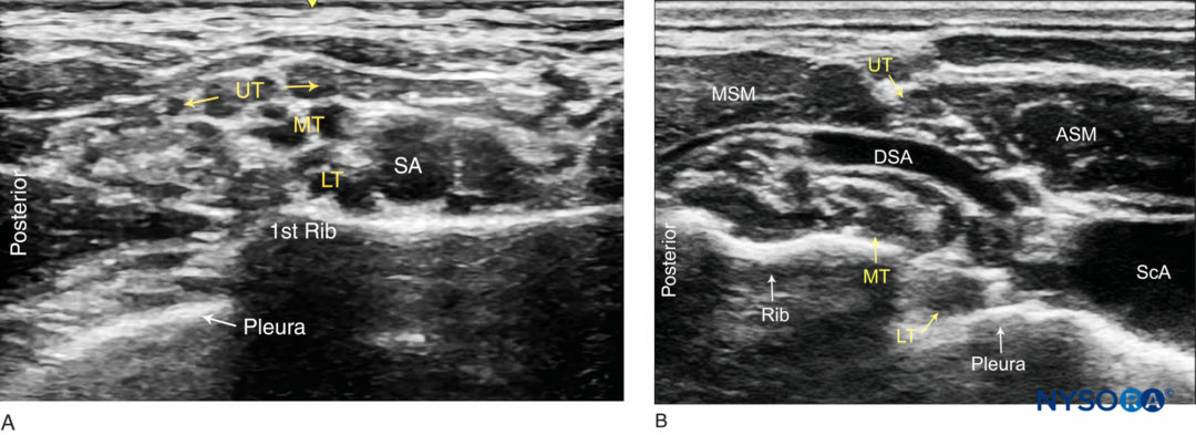 Bloqueo Del Nervio Del Plexo Braquial Supraclavicular Guiado Por Ultrasonido Nysora